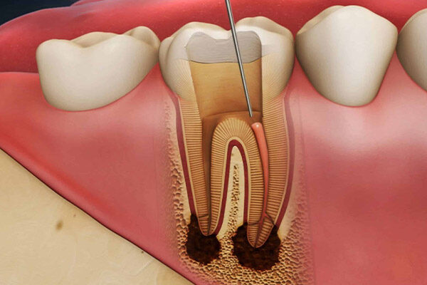 layanan - root canal